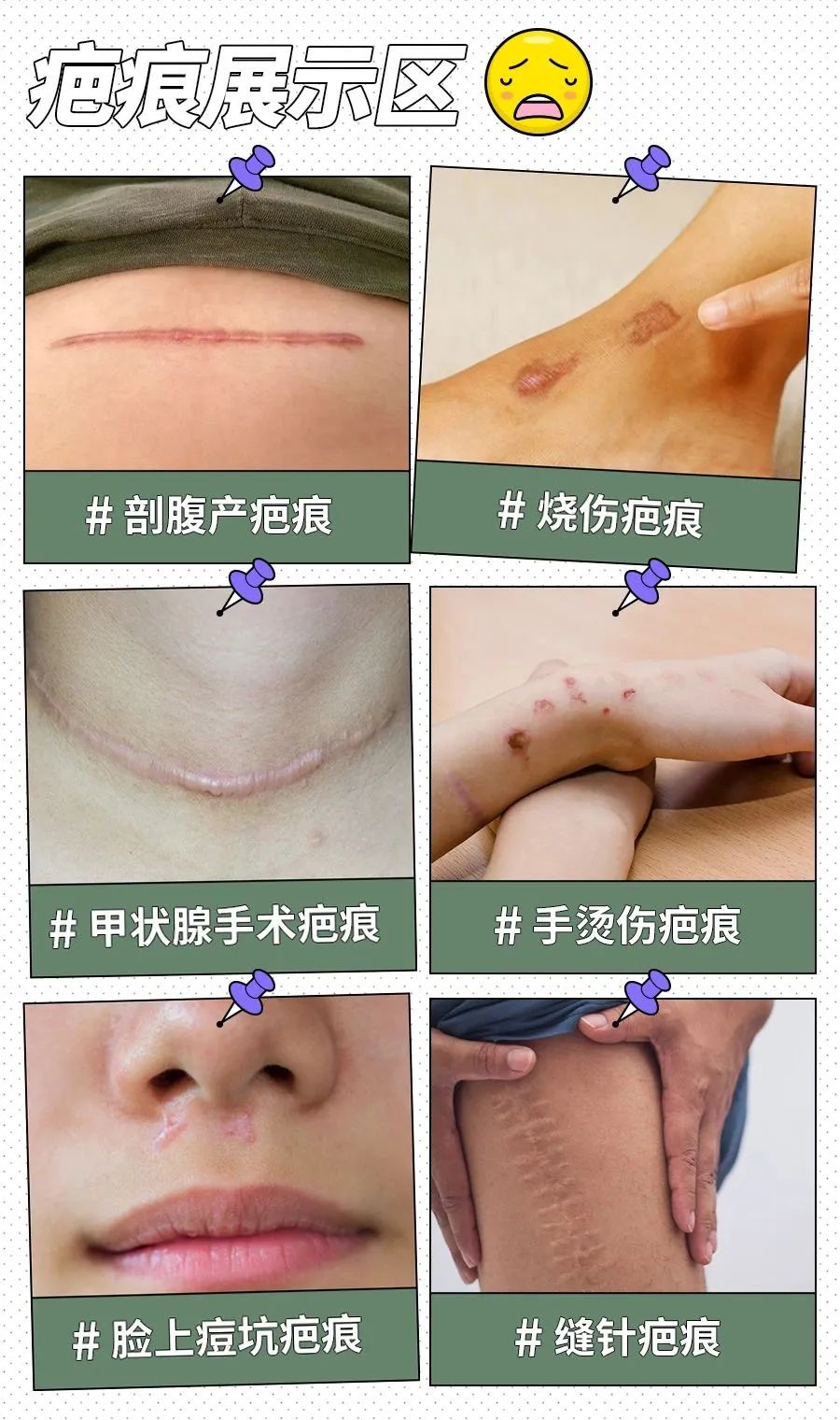 乐舒妍-医用疤痕修复凝胶